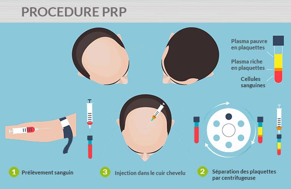 Procédure PRP